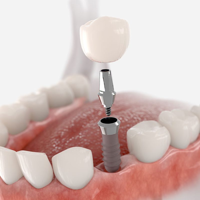 Single_implant