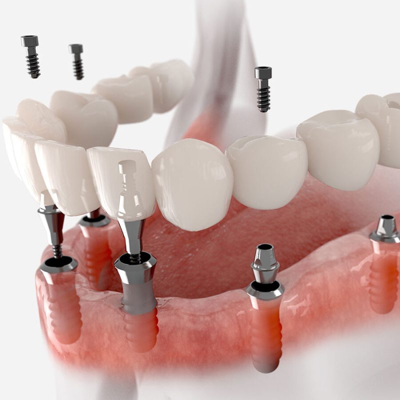 Full Arch Implants (aka All-on-4)