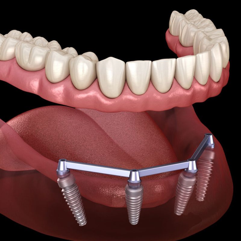 Dentures secured by Implants (Over-dentures)