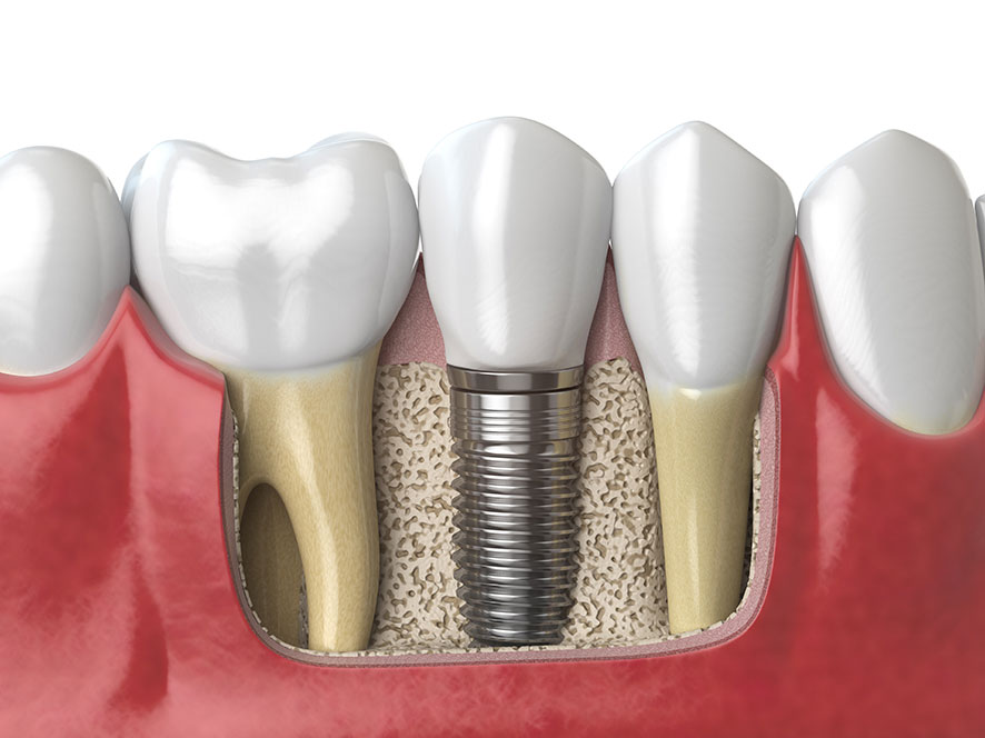 bonegrafting