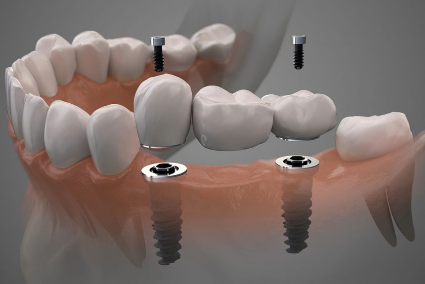 crowns on implant