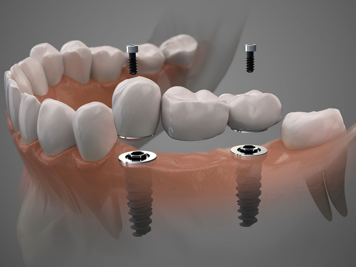 crowns on implant