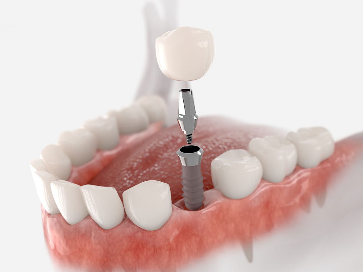 Crowns on Implants Alpine Implant Center