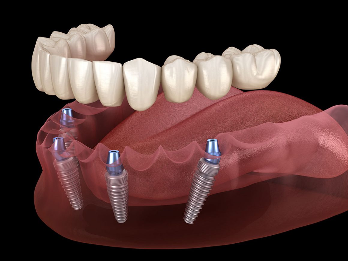 Services & Specialty in Dental Implants Alpine Implant Center