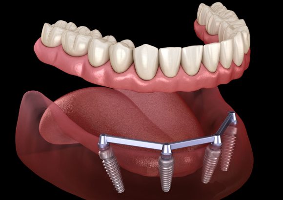 Dentures secured by Implants  (Over-dentures)
