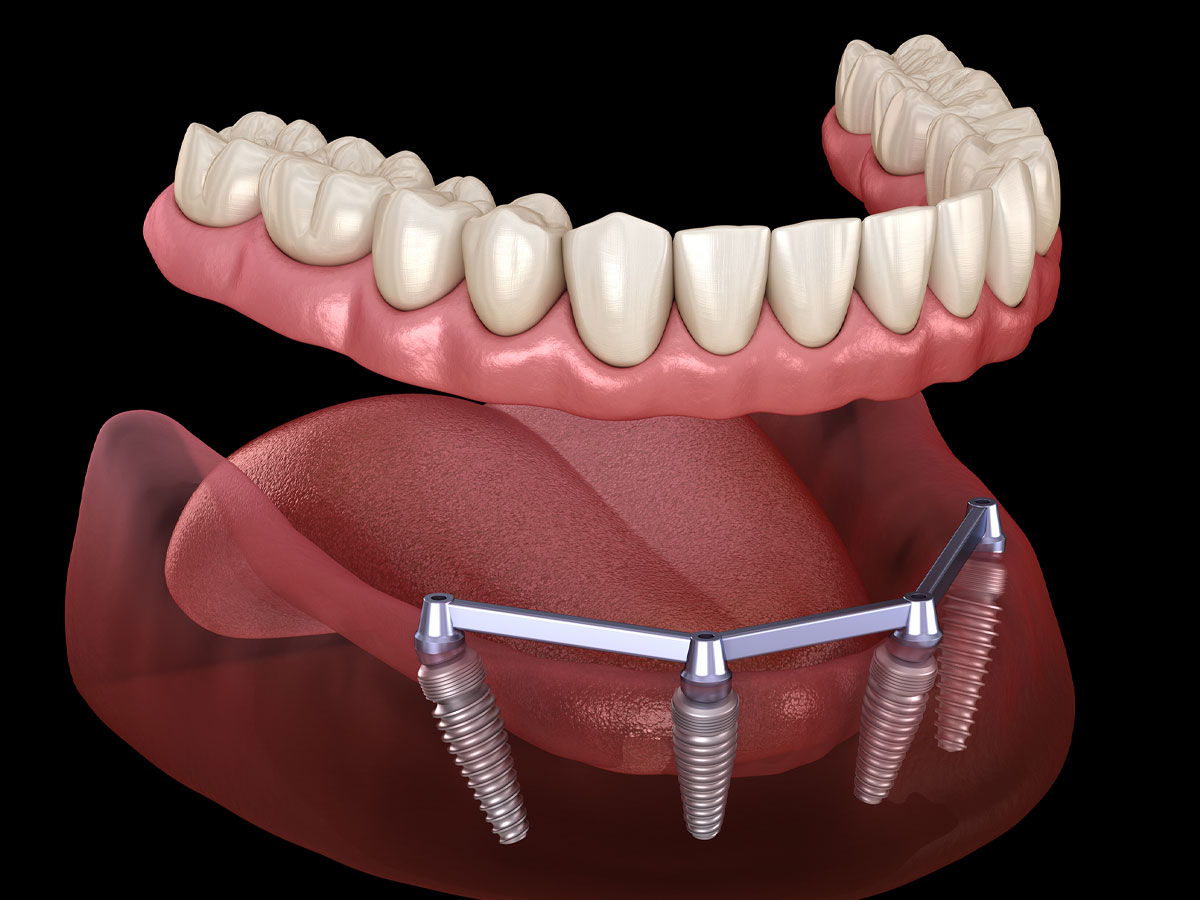 Dentures secured by Implants (Over-dentures)